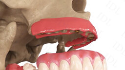 IDL Dental Technologies – Angulated Loc-In Abutment
