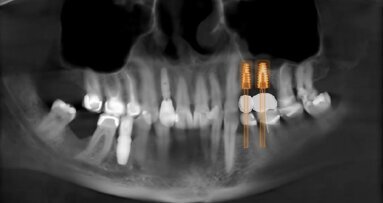 Digital Sinus Planning (DSP) Protocol: Protocollo digitale per programmare una rigenerazione ossea verticale/orizzontale