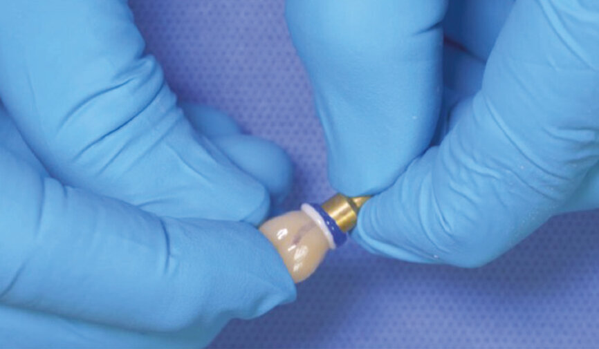 Fig. 9: Align the index points and seat the crown on to the abutment. 