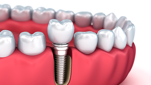 Diagnóstico, manejo y prevención de las enfermedades periimplantarias