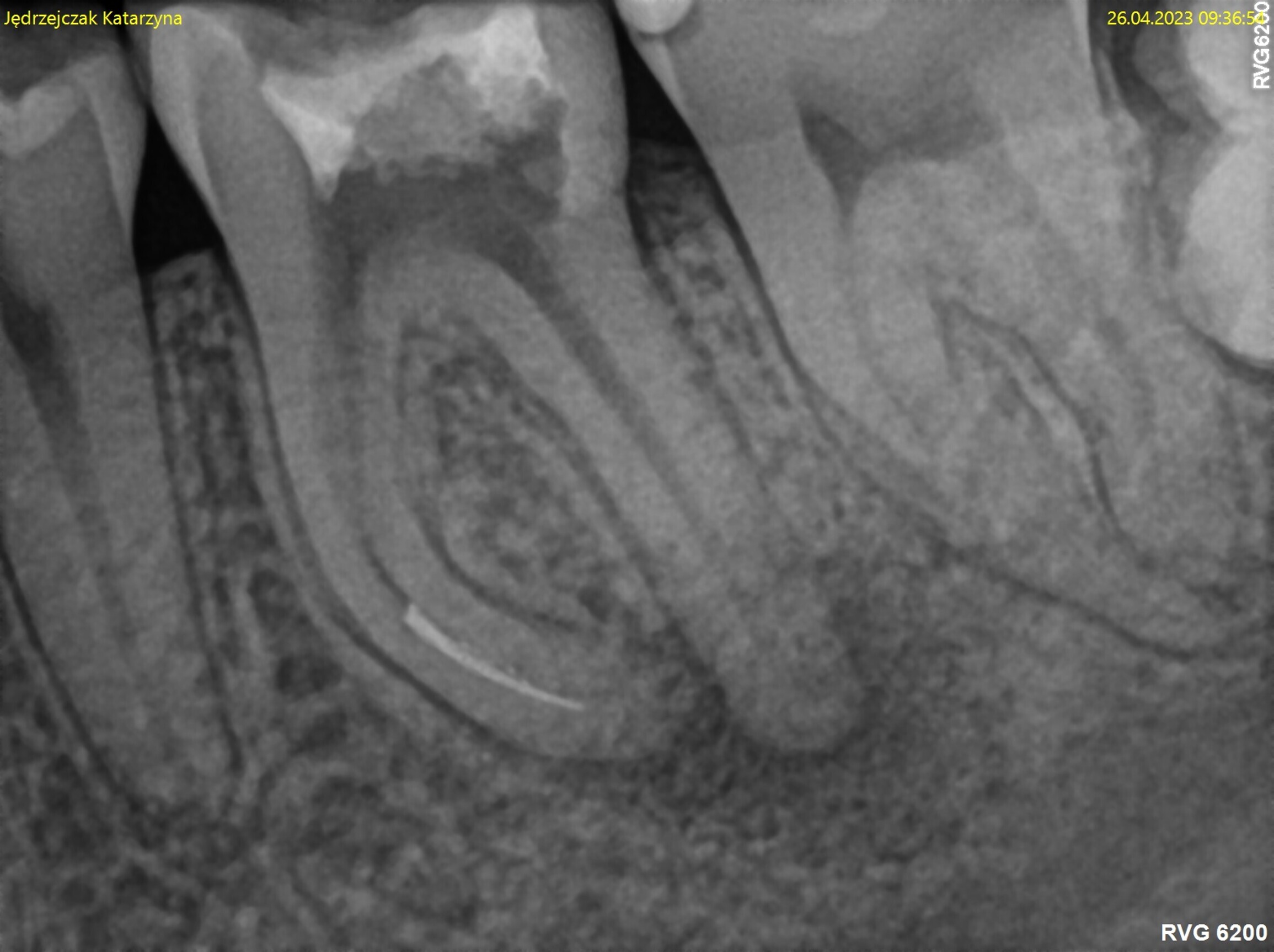 Broken file management with Er:YAG laser and SWEEPS