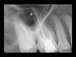 Slika 6:Vitalni prvi gornji molar sa ireverzibilnim pulpitisom. Uočljiv je izrazito dugačak palatinalni kanal (oko 31mm),koji je ipak zapečaćen zajedno sa petljom lateralnog kanalom zahvaljujući dobroj hemijskoj obradi kanala koja je omogućila kompaktnost punjenja.