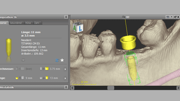 Dental-Wings-Software coDiagnostiX jetzt mit Neodent-Implantaten