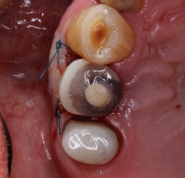 Fig. 19: Post-op situation, occlusal aspect.
