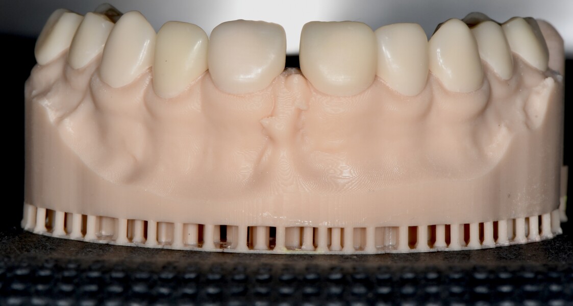 Fig. 7a: 3D-printed restorations on the models.