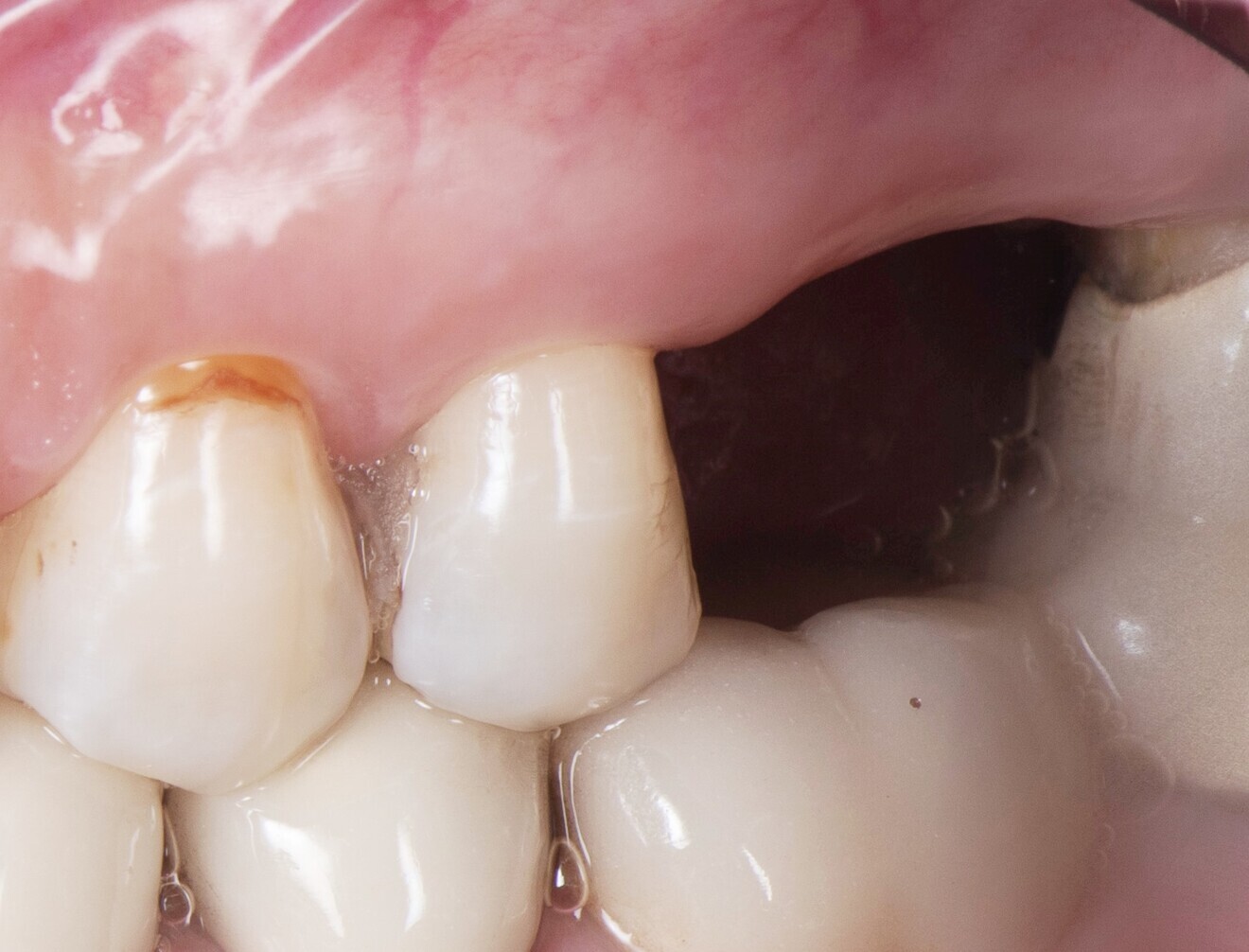 Fig. 1b: Pre-op situation. Buccal view of the edentulous site.