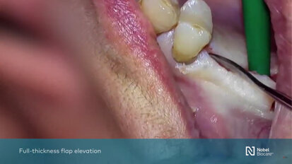 Nobel Biocare - Maxillary sinus floor elevation with simultaneous implant placement with GBR