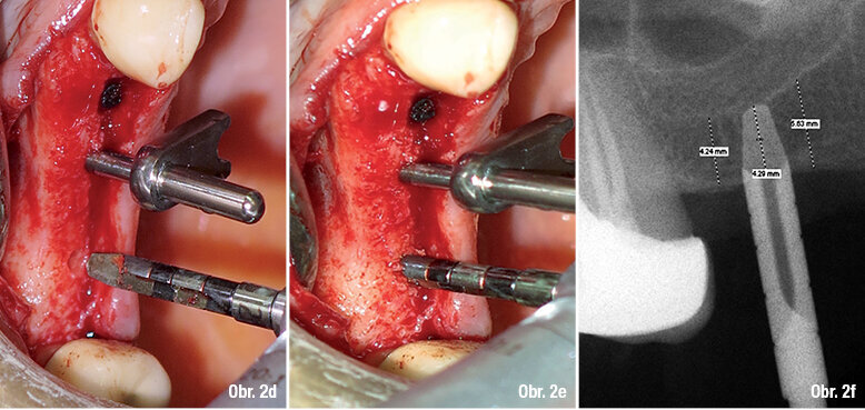 Obr. 2d: 2,5 mm rotační fréza bez řezacích hran pro započetí rozšiřování osteotomie na krestální kosti  Obr. 2e: Perforace 2,5 mm rotační frézou pro rozšiřování kosti  Obr. 2f: RTG snímek znázorňující reziduální výšku alveolární kosti (4,24 mm) a také vložení 2,5 mm rotační frézy do kosti (4,29 mm).