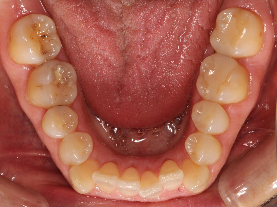 Pre-treatment