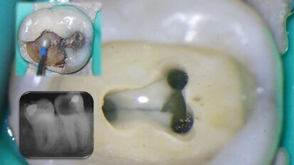 Three questions about the management of complex root canal anatomy