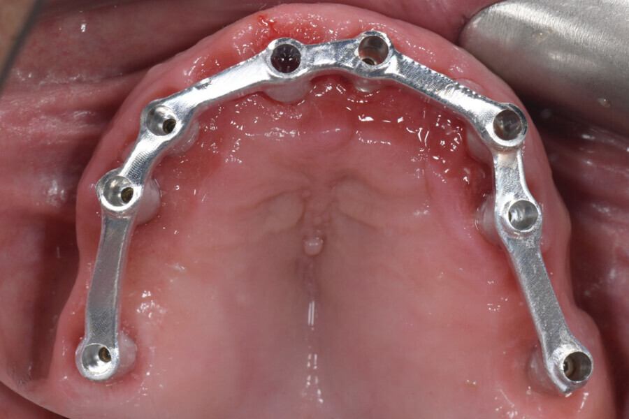 Fig. 15: Intra-oral test of the metal bar to evaluate accuracy and passive fit.