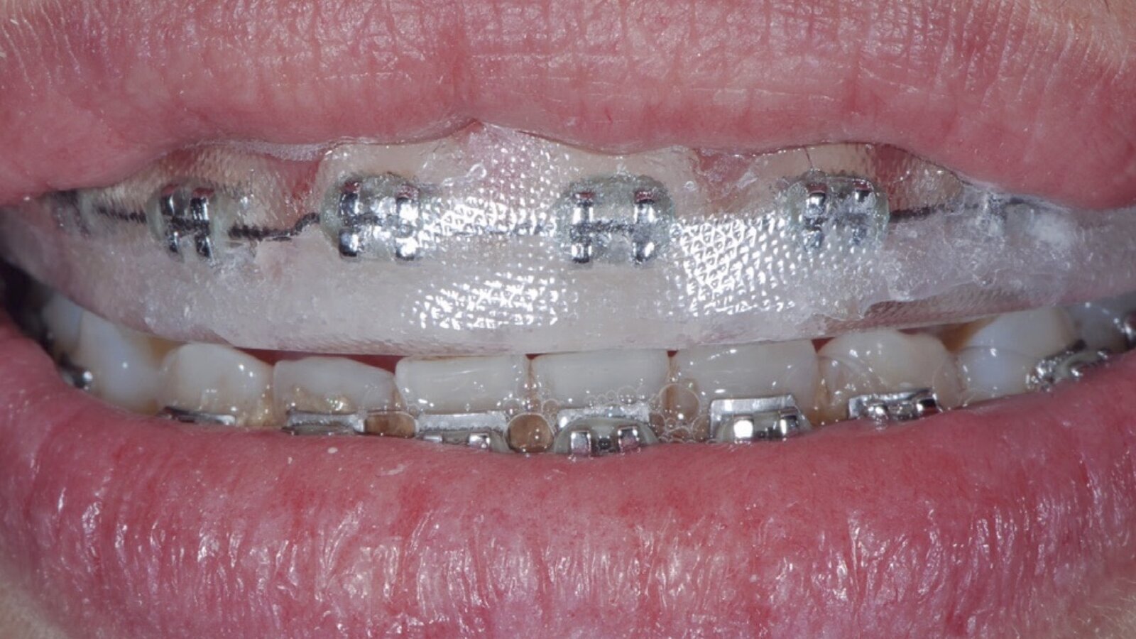 Estética y blanqueamiento dental en la era digital  (Capítulo 15)