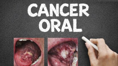 Cómo prevenir la mortalidad del cáncer oral