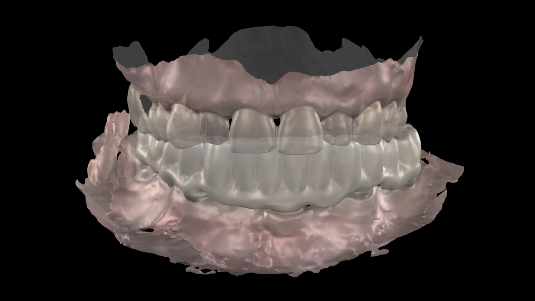Figs. 12a & b: Matching the occlusal relationship with the help of the Medit SmartX workflow.