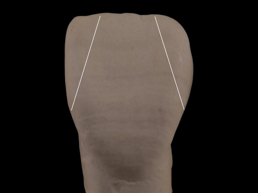 Fig. 9 - Le linee oblique possono cambiare la direzione della trama, dando una prospettiva ristretta alla forma del dente.