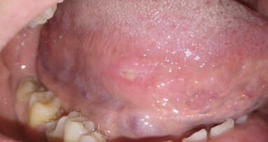 Ulcere traumatiche orali trattate con terapia fotodinamica