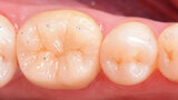 Figs. 12a y 12b. Vista final lateral y oclusal.