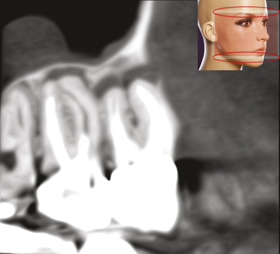 Fig. 1f, 1g - La sezione sagittale mostra ancora meglio le lesioni a carico del primo molare su entrambe le radici vestibolari e le lesioni a carico di entrambe le radici vestibolari del secondo molare, il cui canale MB1 appare completamente vuoto.