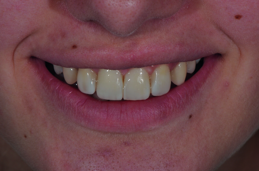 Fig. 3a : Le sourire après redéfinition de la forme des canines en incisives latérales avec le composite Essentia (GC). 