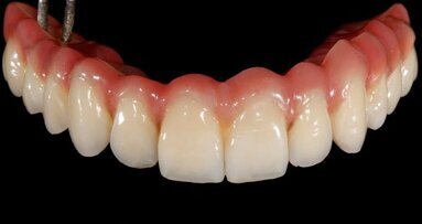 Full-arch reconstruction of the edentulous maxilla with the CAMLOG Guide System