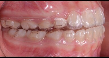 F22 Young, un dispositivo estetico funzionale per il trattamento dei pazienti in crescita con malocclusione di classe II: Case Report