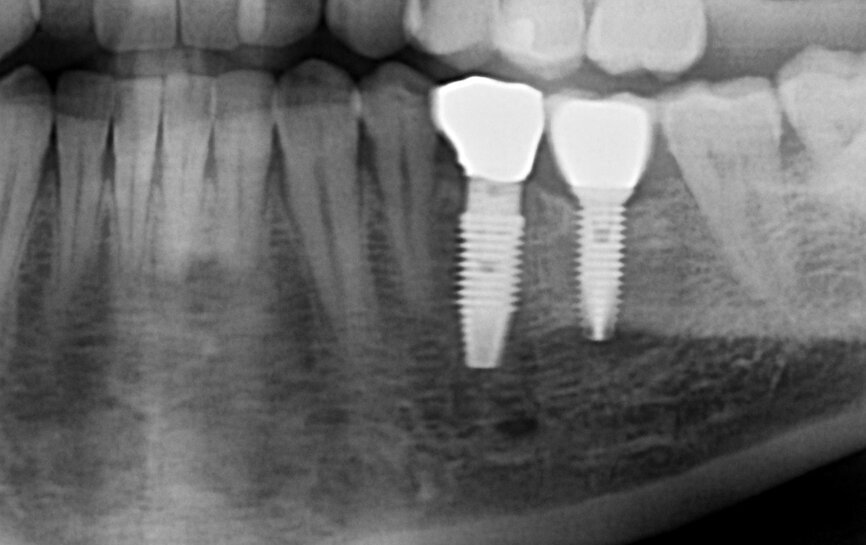 Fig. 9: Radiographic evaluation of the final crown.