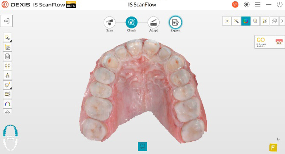Figs. 11a & b: Digital impressions of the maxillary anterior crowns.