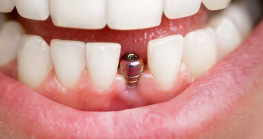 Journal celebrates centennial with article on how implants have influenced restorative dentistry