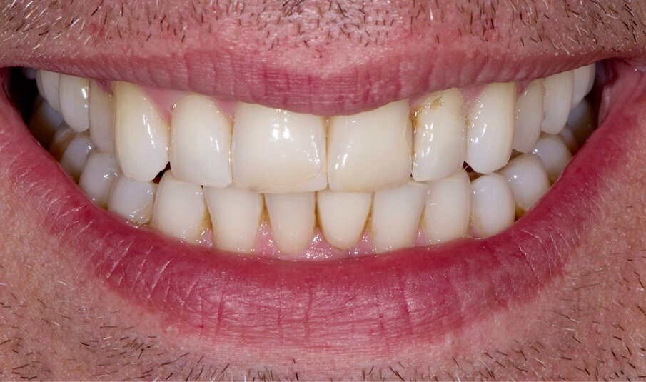 Fig. 1: Starting situation. The upper right 1 and the upper left 1 are to be restored with veneers