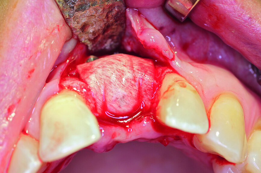 Fig. 6b: Transversal bone augmentation was performed.
