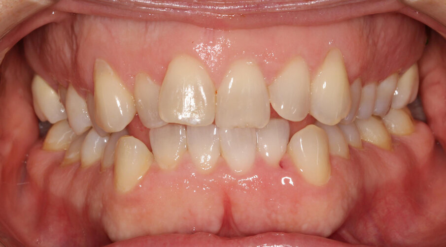 Pre-treatment