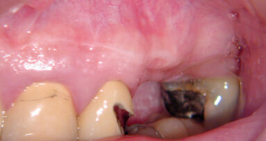 Apical microsurgery: sutures, suturing techniques (Part 6)