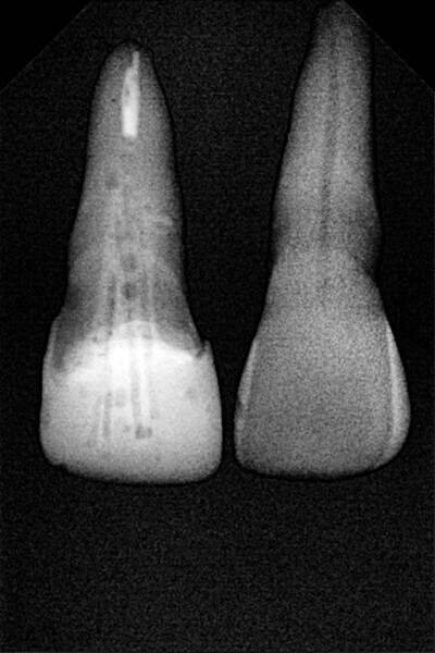 Fig. 20: Radiograph after completion of restoration.