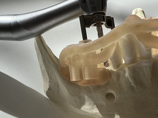 Guided surgery
