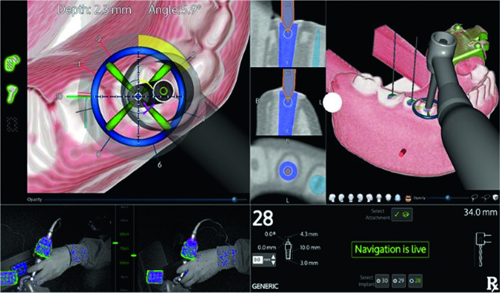 X-Guide is an advanced system that enhances cone beam imaging for more precise and cost-effective implant procedures. (Image: Shepard DeLong)