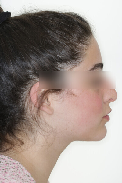 Fig. 20: Final situation after 25 Reveal aligners.