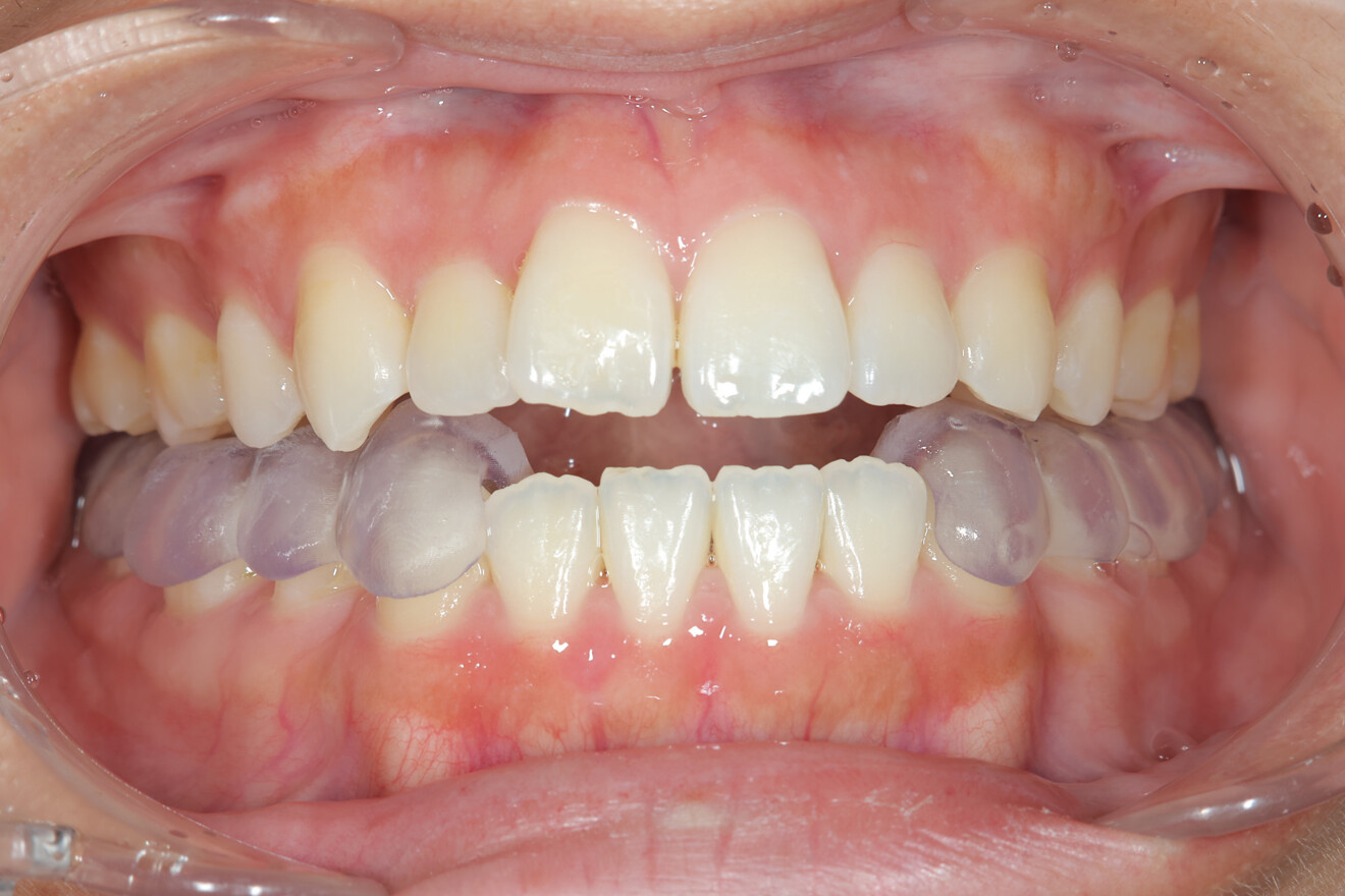 Fig. 2: 3D-printed craniomandibular orthopaedic positioning appliance shown intra-orally.