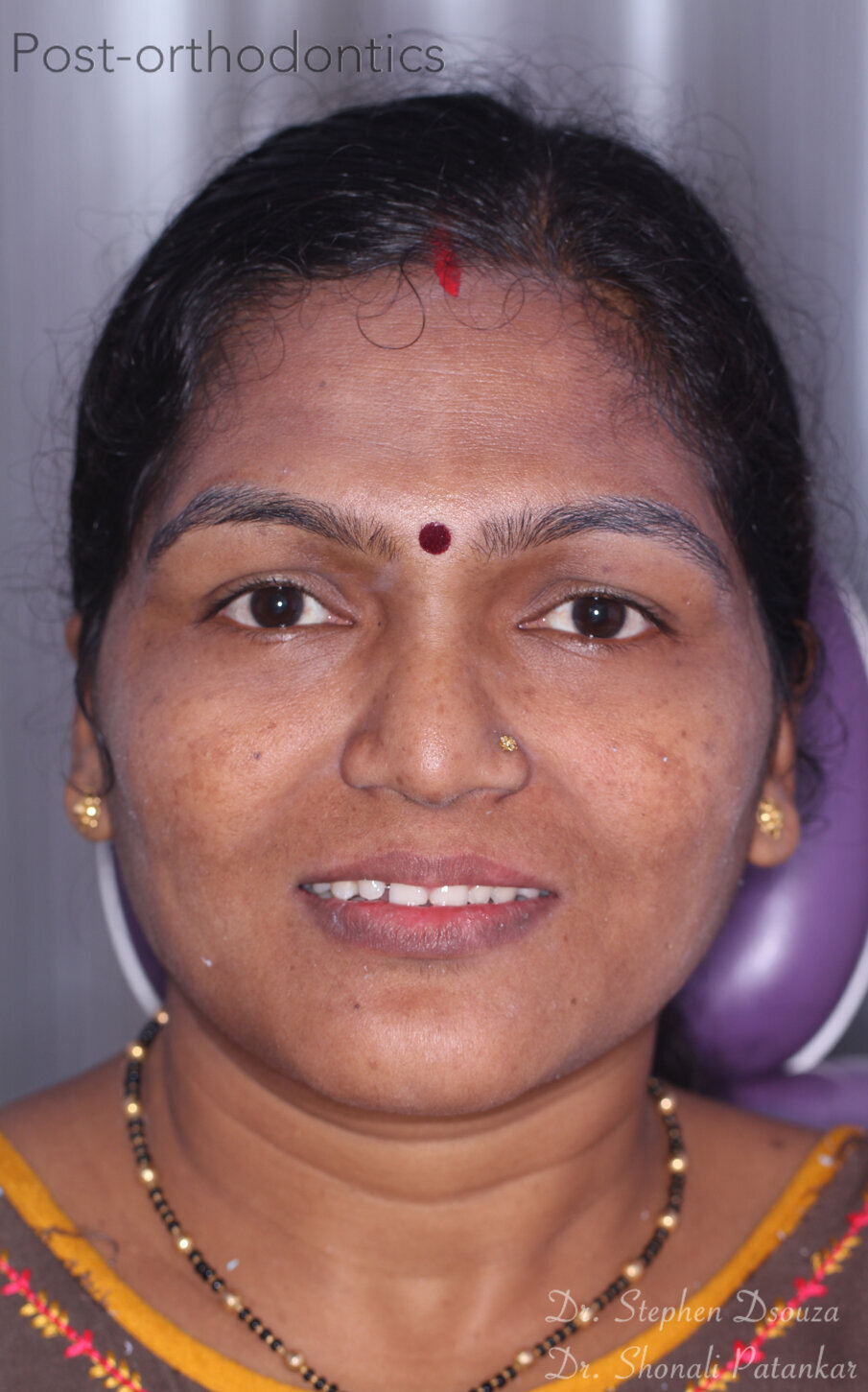 Fig. 3: Smile: post-orthodontic treatment.