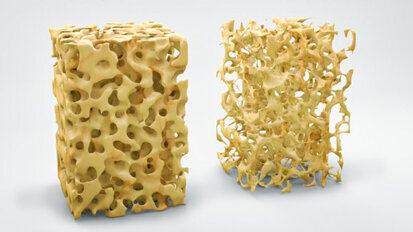 Osteoporosi: gli impianti in magnesio biodegradabili potrebbero promuovere la formazione dell’osso