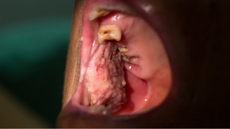 Oral cancers may go undetected during COVID-19 crisis