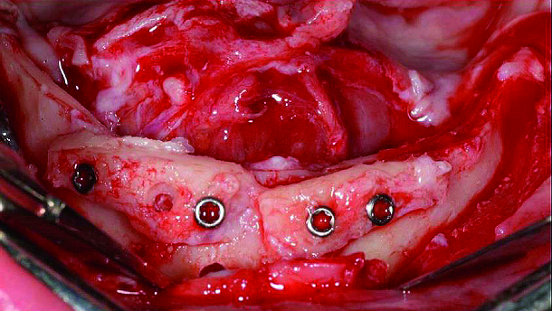 Augmentation and implant treatment: Two-stage surgery in the severely resorbed edentulous mandible