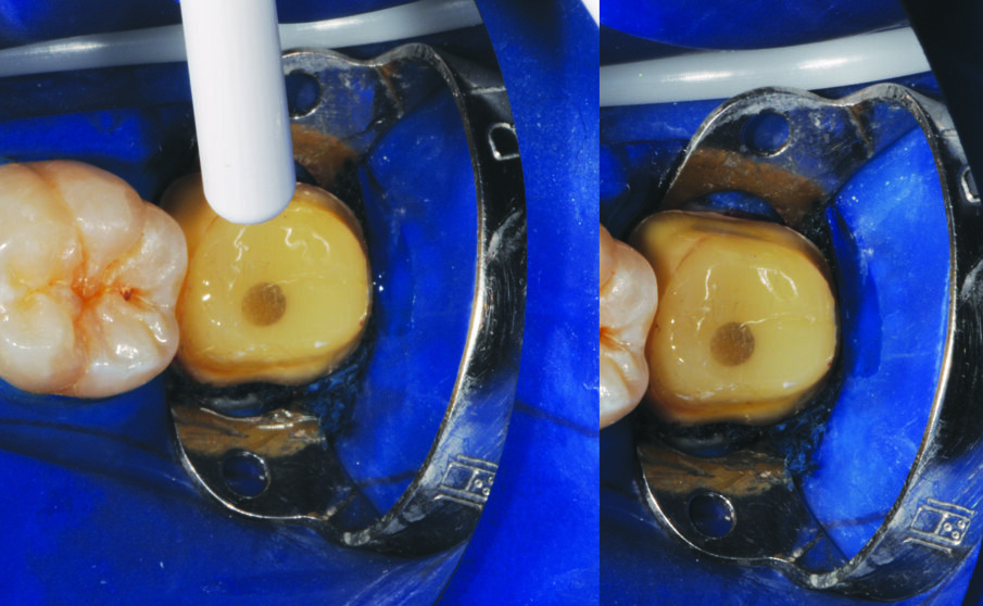 Fig. 8: Gently air thin adhesive with oil-free air for five seconds until the solvent is evaporated and no more ripples are observed.