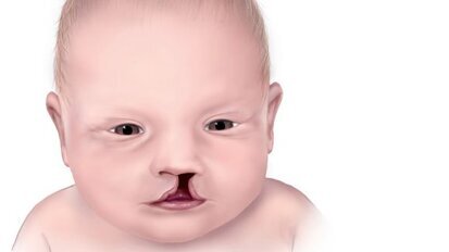 US children with orofacial clefts face healthcare barriers