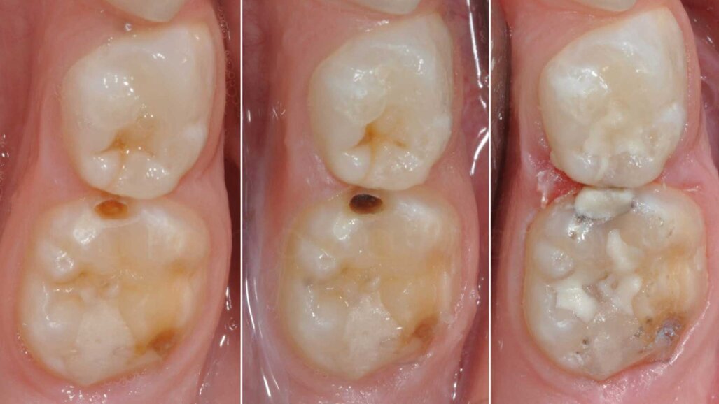 Odontoiatria pediatrica  del minimo intervento: istruzioni per l’uso