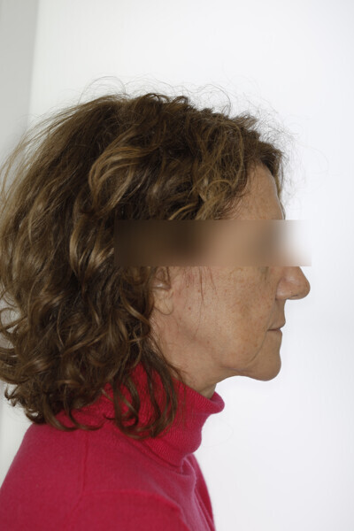 Fig. 44: Situation after 37 Reveal aligners. Case ready for the first refinement. Major change to the patient’s profile.