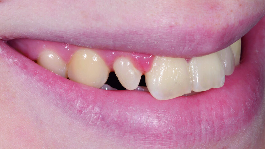 Fig. 12: Crown lengthening was performed on tooth #12.