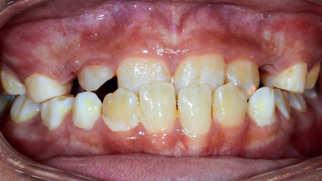 Early correction of anterior cross bite