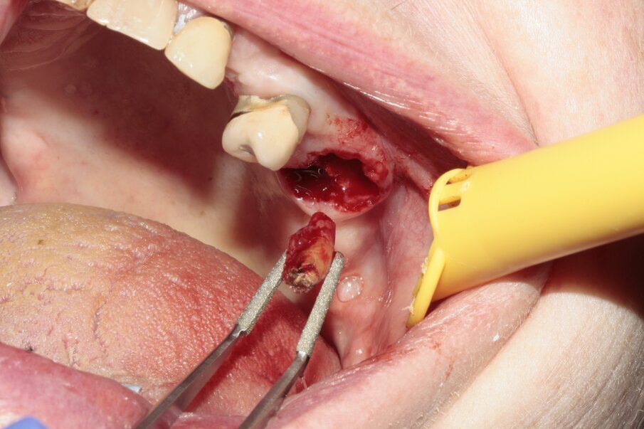 Fig. 9: The mesiobuccal root was removed.
