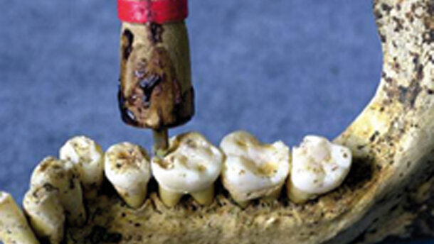 Historia de la odontología. Capítulo I: Primeras técnicas odontológicas