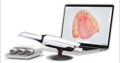 Tecnologías y características de los escáneres intraorales (2)